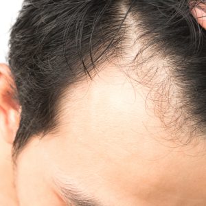 Hair Loss Treatments Restoration Newport Beach Orange County CA