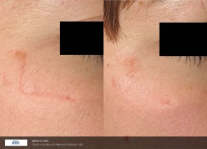 scar treatment